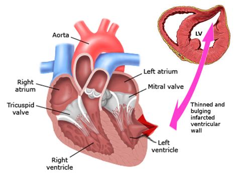 [Figure, Left Ventricular Pseudoaneurysm Contributed by S Bhimji, MD] - StatPearls - NCBI Bookshelf