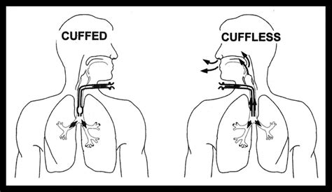 Cuffed vs Cuffless atrach