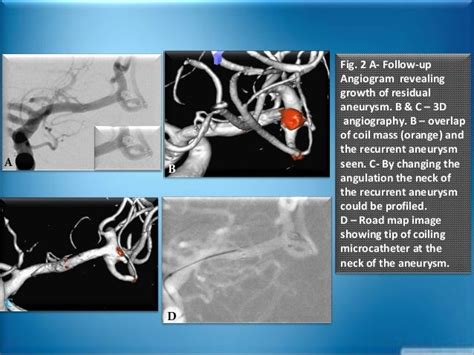 Dissecting MCA Aneurysm