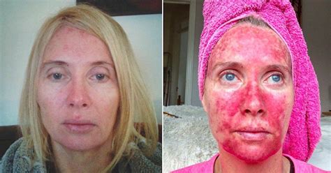 Woman's Before-And-After Pics Show Treatment Post-Tanning