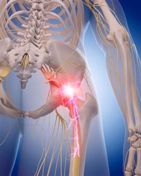 What You Need To Know: Anatomy of the Sciatic Nerve - Spine Center of Texas