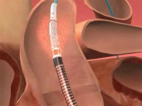 Impella Procedure - YouTube