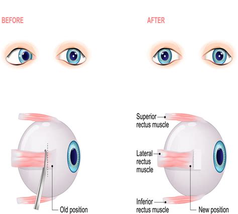 Strabismus Surgery: What to Expect, Recovery, Success Rate