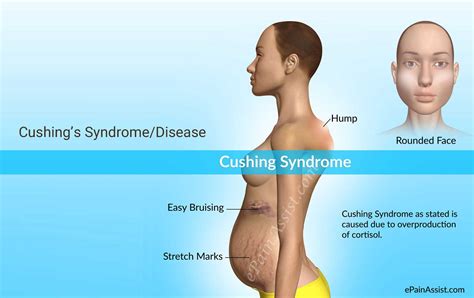 Cushing Syndrome Causes