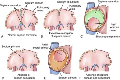 Atrial Septal Defects | Radiology Key