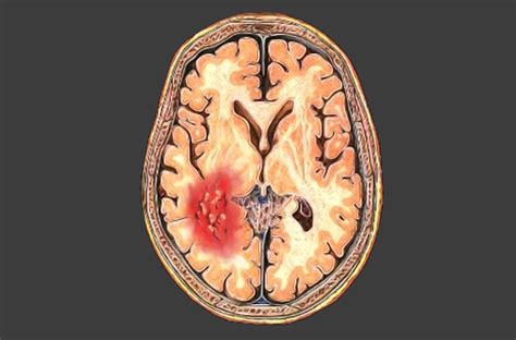 Minimum Headache Duration Prompting Subarachnoid Hemorrhage Workup