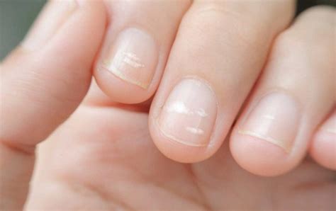 What your weak nails tell you about your health | DietZones