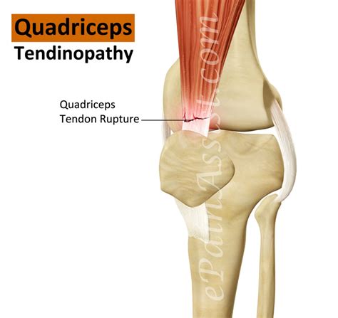 Patellar Tendon/ Quad Tendon Tear - Motus Physical Therapy