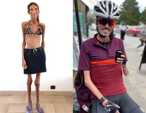 Skinniest Person: Meet 10 World's Thinnest People Alive 2024 - The ...