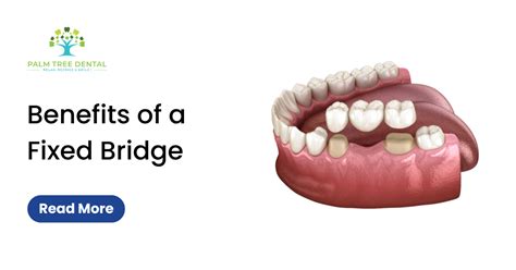 Benefits of a Fixed Bridge - Palm Tree Dental