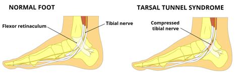 The Tarsal Tunnel - Borders - Contents - Compression - TeachMeAnatomy