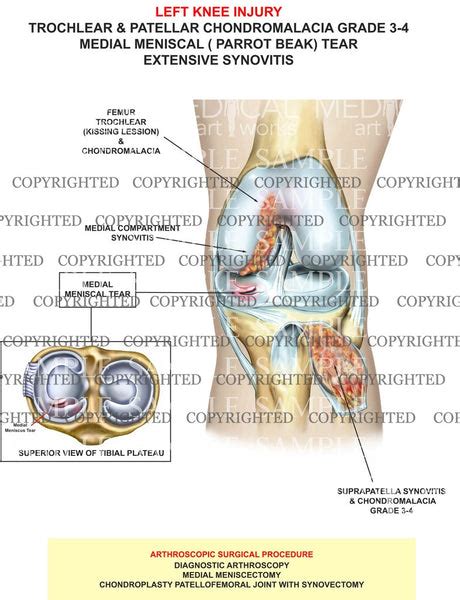 Trochlear & Patellar Chondromalacia — Medical Art Works