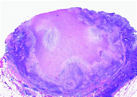 40 Caseating granuloma in lymph node from patient with cutaneous ...