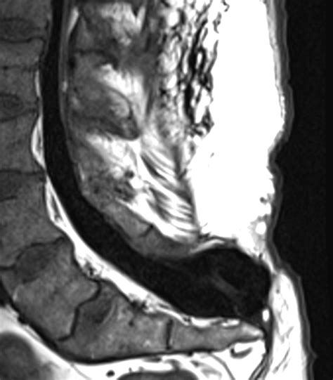 Sacral spinal dysraphism with a meningocele. — Clinical MRI