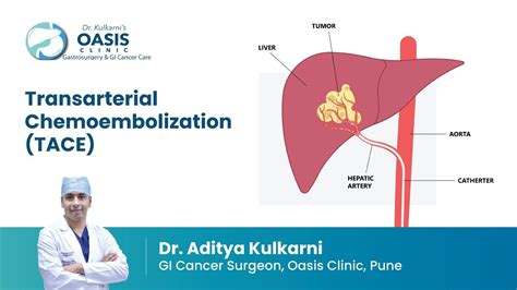 Liver Tumour में TACE Procedure क्या होती है? | TACE For Liver Cancer in Hindi | Dr Aditya ...