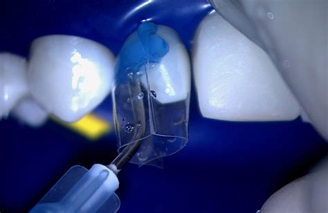 Bioclear Composite Overmolding for Post-Orthodontic Undersized Teeth ...