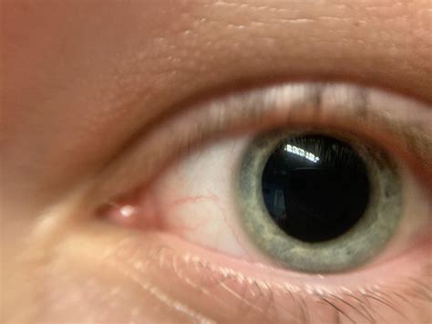 Should I be worried that my pupil is incredibly dilated? It just looked ...