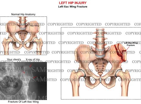 Left hip iliac wing fracture – Medical Art Works