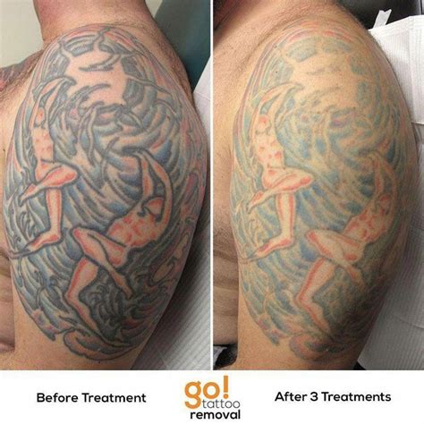 This large piece is showing substantial fading after 3 laser tattoo removal treatments. Most of ...