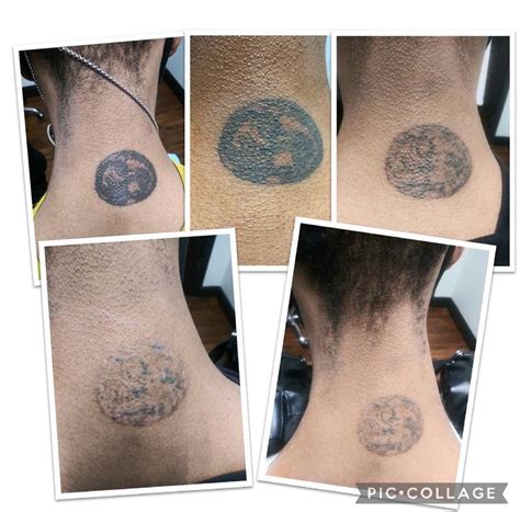 Enlighten Laser Tattoo Removal | Medical Aesthetics of Suwanee