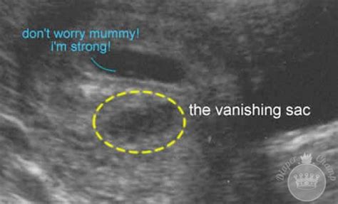 what-is-vanishing-twin-syndrome | Vanishing twin syndrome, Medical ...