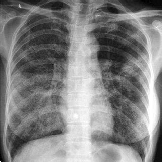 (PDF) Cystic changes in mucosa-associated lymphoid tissue lymphoma of lung: A case report