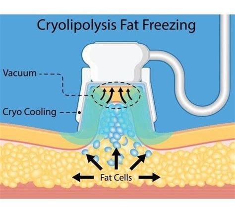 What Is Fat Freezing - Risks, Benefits And Side Effects (2022) | Fabbon