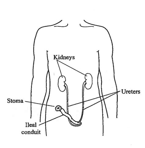 Radical Cystectomy with Ileal Conduit Urinary Diversion :: Department ...