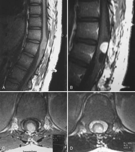 Intramedullary Spinal Cord Tumors in Children | Clinical Gate