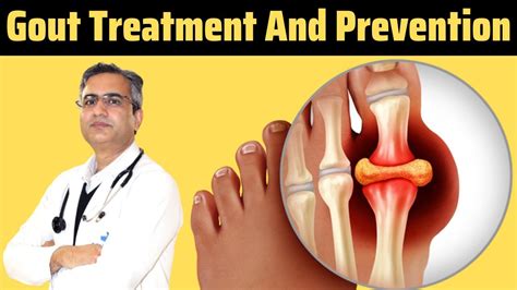 Gout Symptoms | Gout Treatment | 10 Minute Gout Cure | Immediate Gout ...