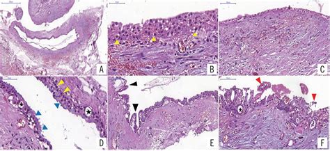 SciELO - Brasil - Glandular odontogenic cyst: report of an unusual case in the posterior ...