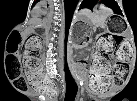 Abdominal CT scan revealing a severe fecal impaction. | Download Scientific Diagram