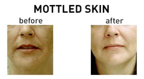 Mottled Skin - Pictures, What is, Causes, Treatment, Diagnosis