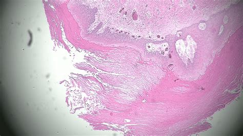 Pedicab Énfasis crisantemo pilar cyst histology índice novato Condición