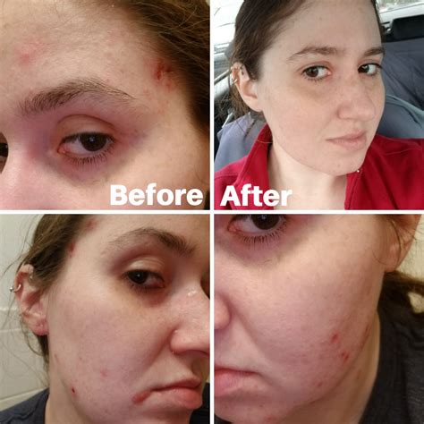 Before & After I learned I had fungal acne : r/Fungalacne