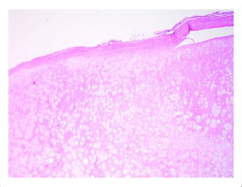 Histological section showing the pulmonary chondroma | Download Scientific Diagram