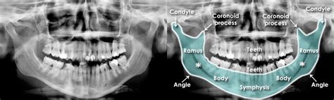 Dislocated Jaw X Ray