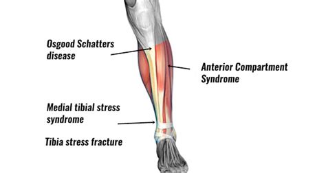 Shin Pain - Symptoms, Causes, Treatment & Prevention