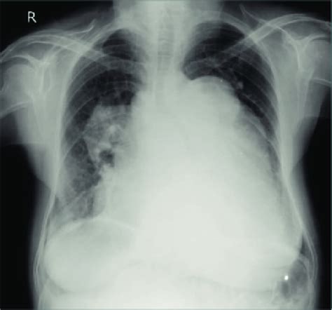 Showing massive cardiomegaly on chest x-ray PA view. Figure 2. Showing... | Download Scientific ...