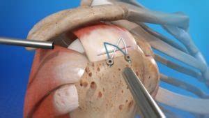 Rotator Cuff Surgery Outcomes Cleveland Shoulder Institute