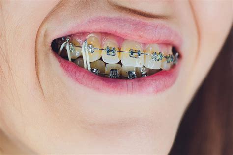 Braces in Irving | Do I Need to Wear Elastics? | Bite Misalignment