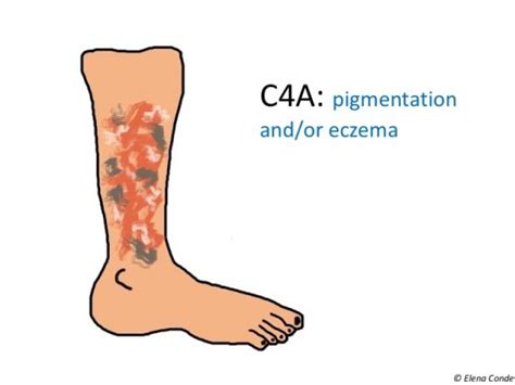 Chronic venous insufficiency from a dermatological perspective - Elena Conde