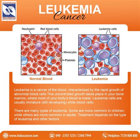 Comprehensive Guide to Leukemia: Symptoms, Causes, Treatment, Types ...