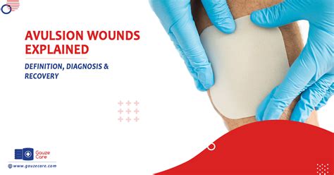 Quick Guide To Avulsion Wounds: Diagnosis & Recovery