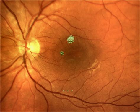 Central Serous Chorioretinopathy