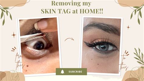 Removing my SKIN TAG from my eyelash at HOME!! - YouTube