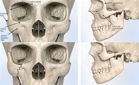 Zygoma Fracture