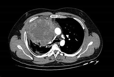 Teratoma (patient information) - wikidoc