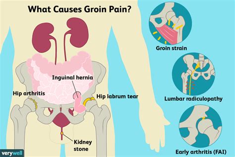 Groin Pain: Causes, Treatment, and When to See a Doctor