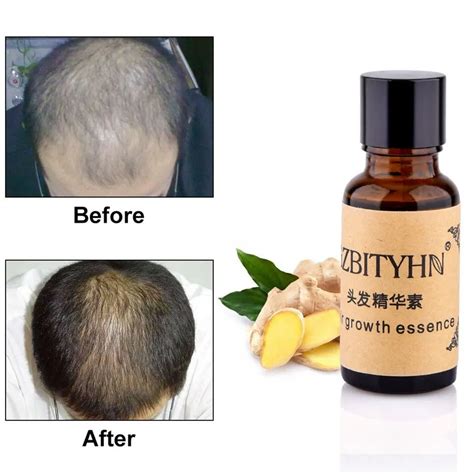 1 PCS Hair Growth Essence Hair Loss Liquid Natural Pure Nut Essential ...